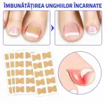 Plasturi pentru unghii incarnate 10 buc
