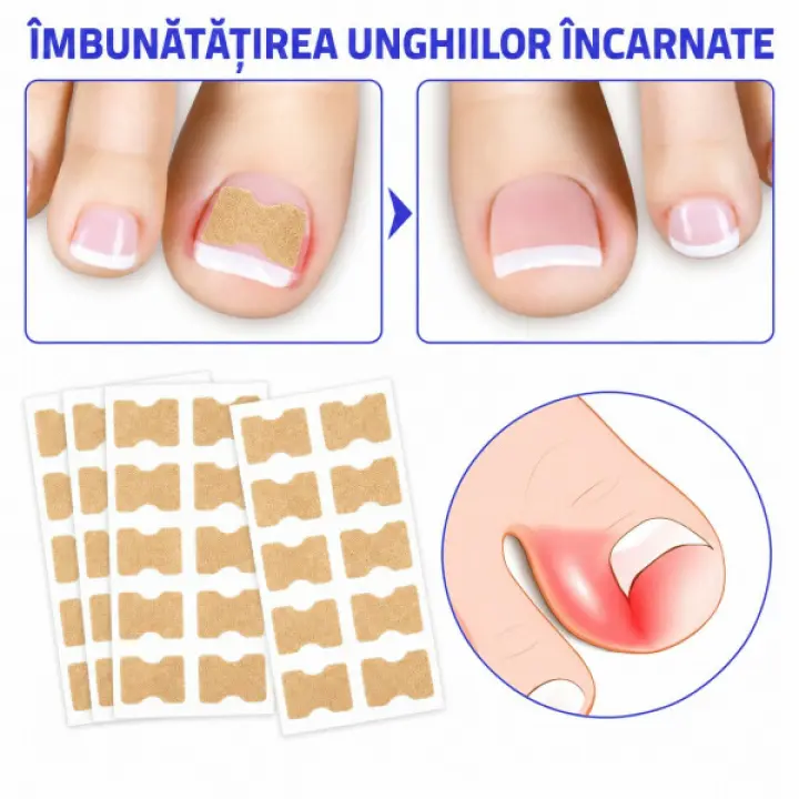 Plasturi pentru unghii incarnate 10 buc
